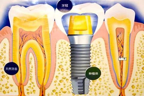 種植牙齒有什么壞處-義齒廠家