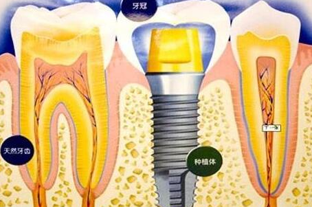 種植牙齒有什么壞處-義齒廠家