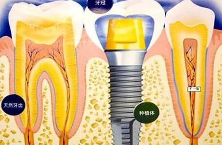 種植牙齒有什么壞處-義齒廠家