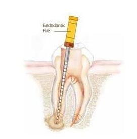 什么叫根管治療-四川義齒廠家