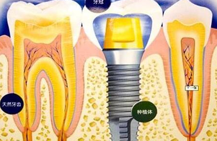 種植牙齒有什么壞處-義齒廠家