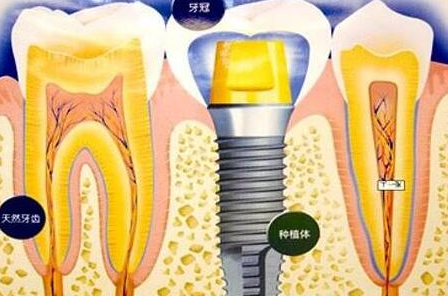 種植牙齒有什么壞處-義齒廠家