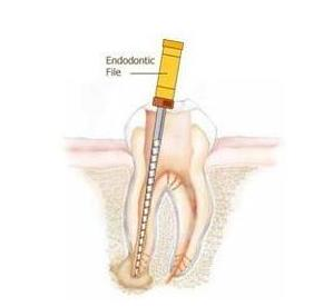 什么叫根管治療-四川義齒廠家