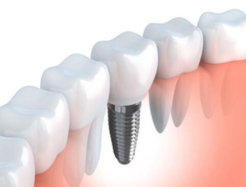 整個種植牙修復(fù)過程要多久-四川義齒廠家