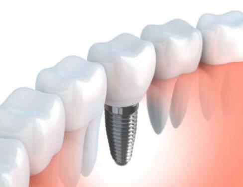 整個種植牙修復過程要多久-四川義齒廠家