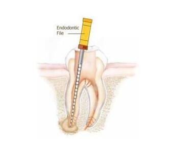 什么叫根管治療-四川義齒廠家