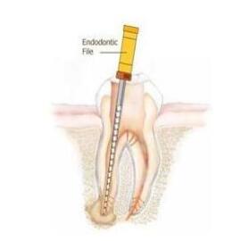 什么叫根管治療？ |  四川義齒廠家